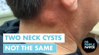 Two Neck Bumps vs. Dr. Pimple Popper | But They're NOT the Same!