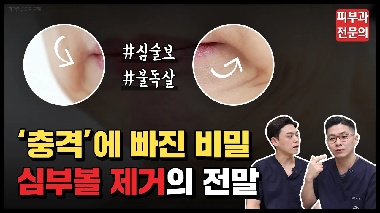 못생겨 보이는 얼굴 심술보, 불독살 수술 없이 없애는 법