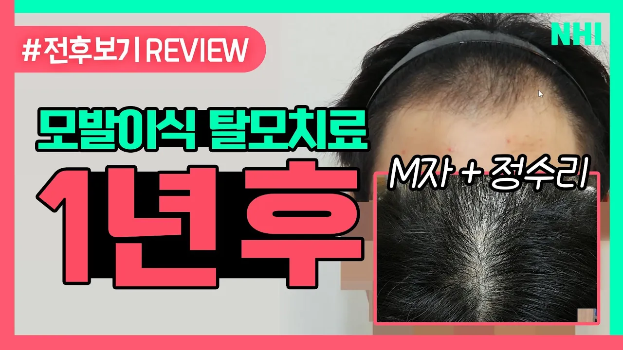 M자 모발이식 + 정수리 탈모치료 1년 후 놀랍습니다ㅣ전후보기reviewㅣ뉴헤어