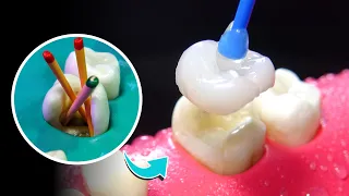 Root Canal Treatment With ROTARY ENDODONTICS  #dentist #rootcanal