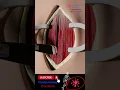 Download Lagu Tracheostomy procedure 3D animation
