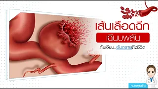 เส้นเลือดแดงใหญ่ฉีกเฉียบพลันคืออะไร และเกิดที่ไหนในร่างกาย