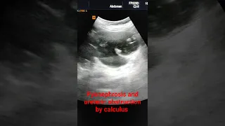 Gross pyonephrosis with upper ureteric obstruction by calculus