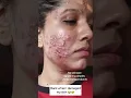 Download Lagu best 3 niacinamide serum for acne marks under 250#shorts #youtubeshorts#acneproneskin #acnetreatment