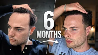 6 Month Hair Transplant Transformation Not What i Expected SmileHairClinic