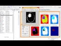 MATLAB code Brain Tumor Segmentation Detection using SOM Watershed