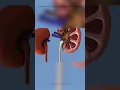 Download Lagu Metode Laser Batu Ginjal Tanpa Operasi RIRS \u0026 PCNL - Mandaya Royal Hospital Puri