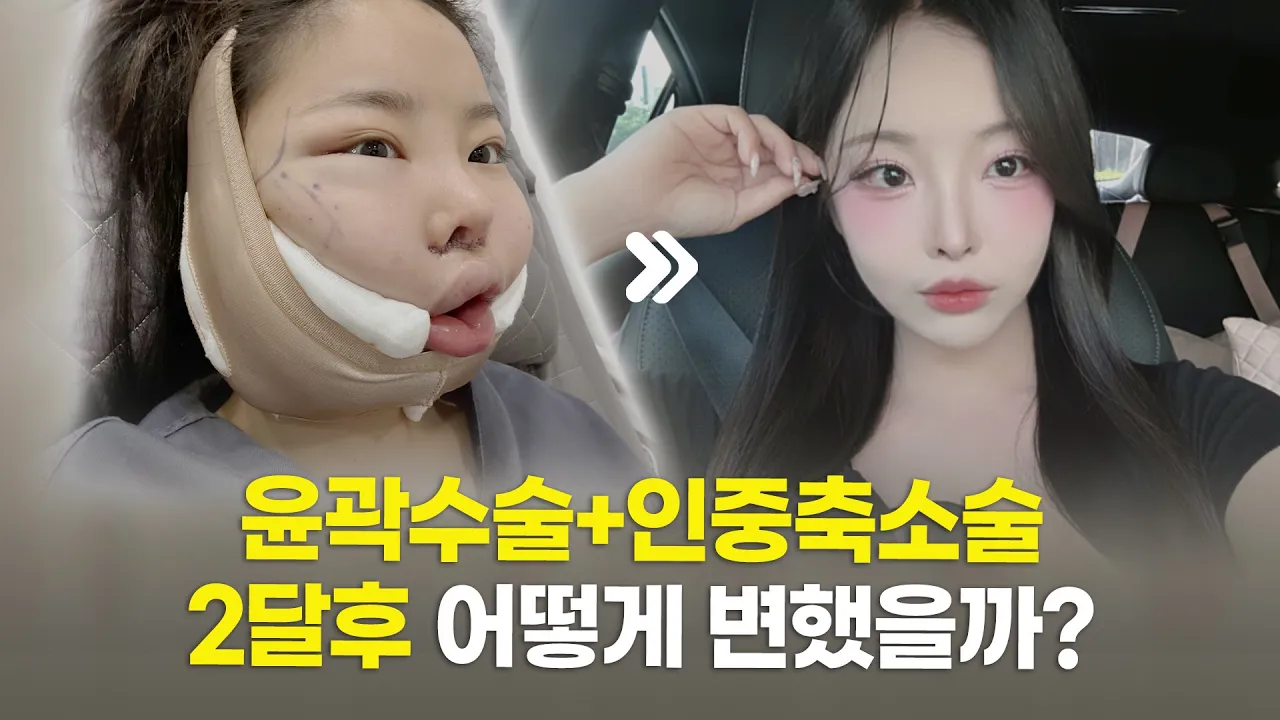 예쁜데, 더 예뻐졌다😍 윤곽수술(광대, 사각턱), 인중축소술 후기💖
