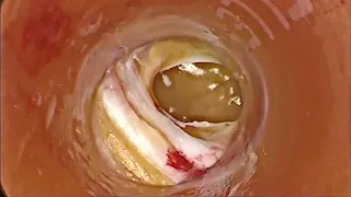 جراحی اسلیو معده 