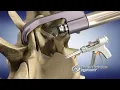 Download Lagu CTL Amedica (US SPINE): FacetGun Max Facet Fixation System
