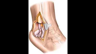 Osteotomy Ankle CPT code - simplify medical coding