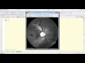 GLAUCOMA DETECTION USING ARTIFICIAL NEURAL NETWORKS MATLAB Ieee Projects Bangalore