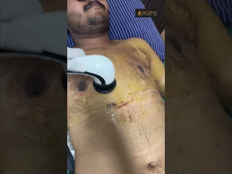 Gynecomastia dressing and RF Session
