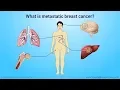 Download Lagu Understanding metastatic breast cancer