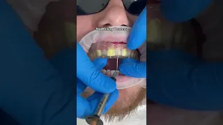 Predesigned composite veneers technique