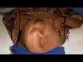 Download Lagu The Breech Birth - Childbirth Series