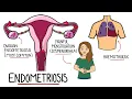Endometriosis Explained Signs Symptoms Diagnosis Pathology Treatment