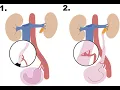 Ureterolysis CPT code - simplify medical coding