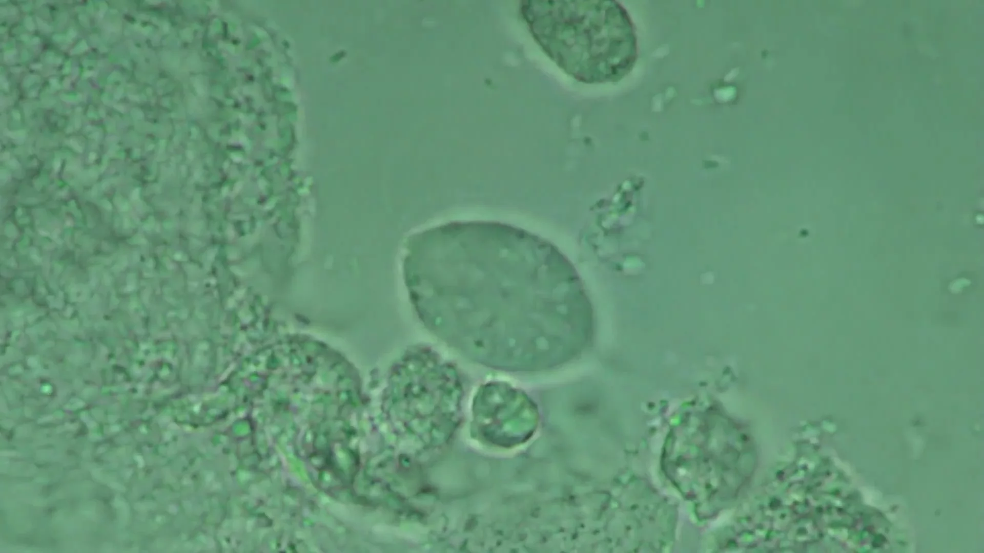 Gyneacology. Trichomoniasis. Trichomonas vaginalis.