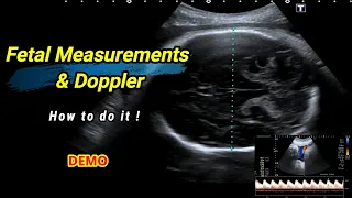 Fetal measurements and Doppler How to do it