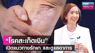 โรคสะเก็ดเงินมีผลต่อระบบอื่นของร่างกายหรือไม่