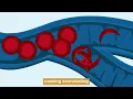 Sickle Cell Disease What You Need to Know