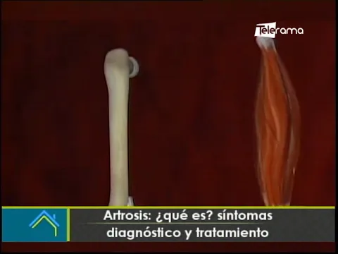 Artrosis: ¿Qué es? síntomas, diagnóstico y tratamiento