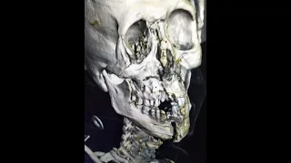 اخطر إصابة في كرة القدم بكاس العالم      دندنها