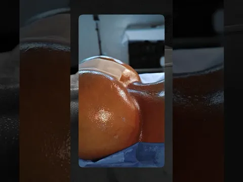 O SEGREDO DO GLÚTEO EM CORAÇÃO INVERTIDO REVELADO! ✨ A técnica exclusiva da Dream Clinic!