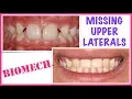 Orthodontics Course - missing lateral incisors and braces