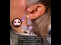 Download Lagu Arthrocentesis of a Wilkes Stage 3 TMJ #arthrocentesis