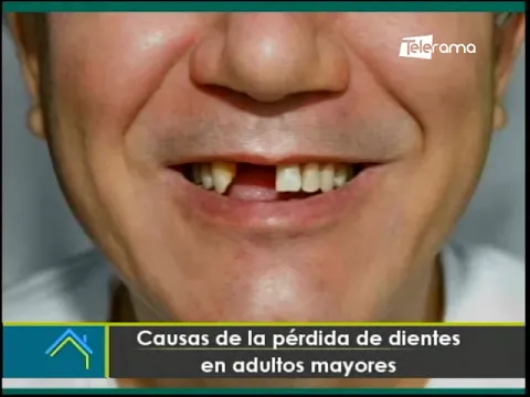 Causas de la pérdida de dientes en adultos mayores