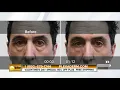 Get Rid of Crow s Feet and Fine Lines with Plexaderm Skincare