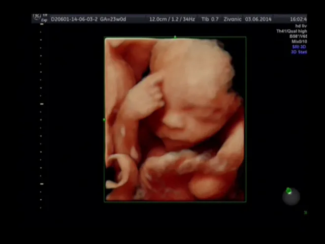 Ekspertski 4d Ultrazvuk Od 24 Nedelje Trudnoce Opsta Bolnica Analife