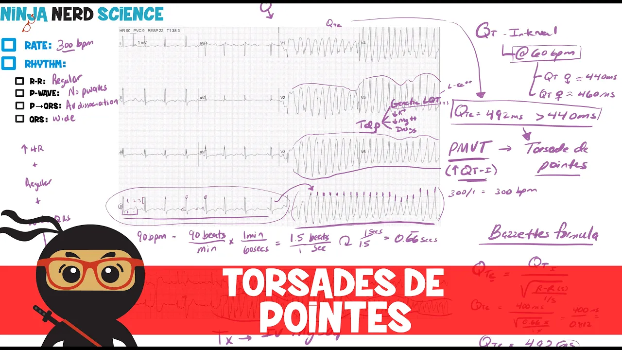 Rate and Rhythm | Torsades de Pointes