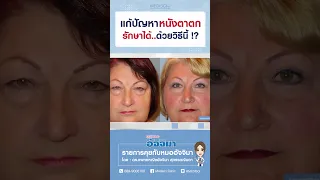  วิธีการรักษาหนังตาตกแบบไม่ผ่าตัดมีอะไรบ้าง 