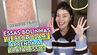 QUERATOSE PILAR ✨ APRENDA A TRATAR DE UMA VEZ POR TODAS!
