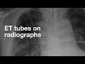 ET Tubes on Chest X-ray