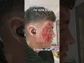 Download Lagu C02 Laser Acne Scars Before VS After