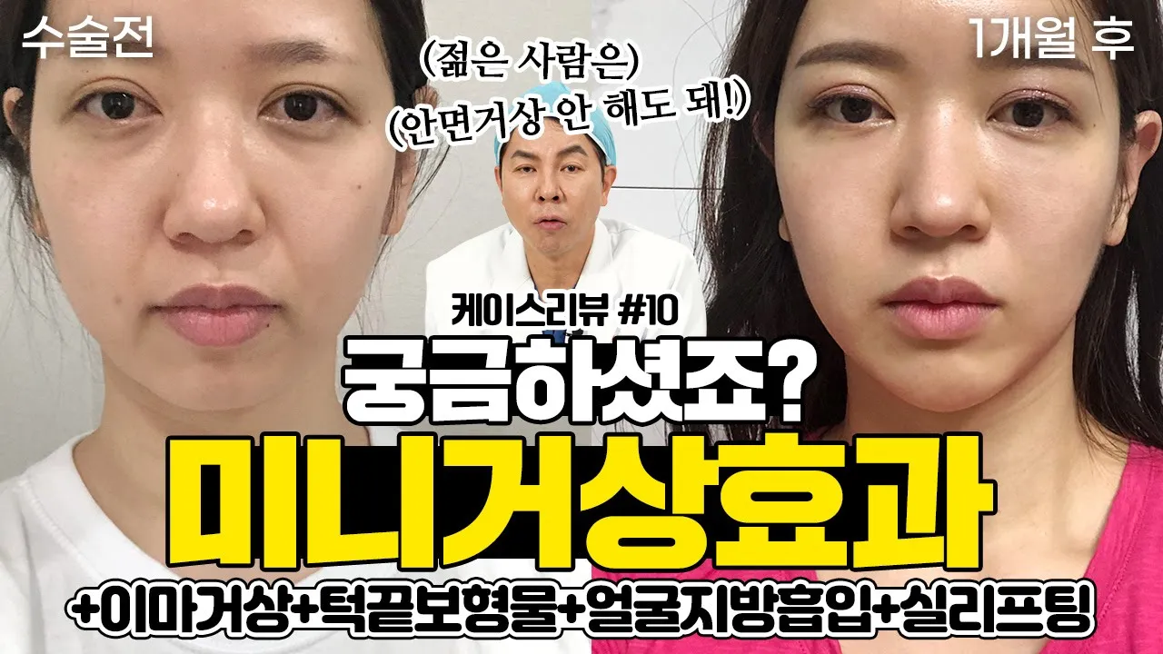 케이스리뷰 10화 [미니거상의 효과 드디어 공개합니다!]  #미니거상 #이마거상 #얼굴지방흡입 #턱끝보형물