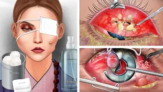 ASMR Best Treatments for Eyes with Cataracts, Ocular Inflammation, Worms and Pimples in the Eye