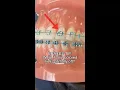 Braces Hack Colored Tie Falling Off