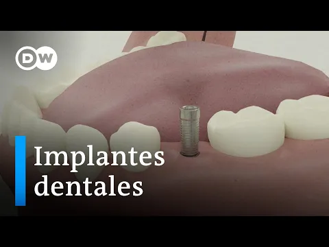 Download MP3 Implantes dentales: ventajas e inconvenientes