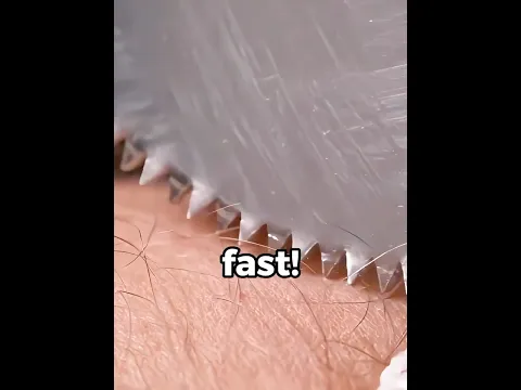 They Remove Casts With A SAW?! 😳
