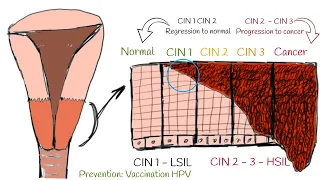 Download CIN - Cervical intraepithelial neoplasia (cervical dysplasia). CIN I; CIN II; CIN III explained MP3