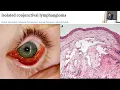 Lagu AIOCMTC4 2025 - GP50 - Just Cases - Ocular Pathology / Ocular Oncology and Tumors - I
