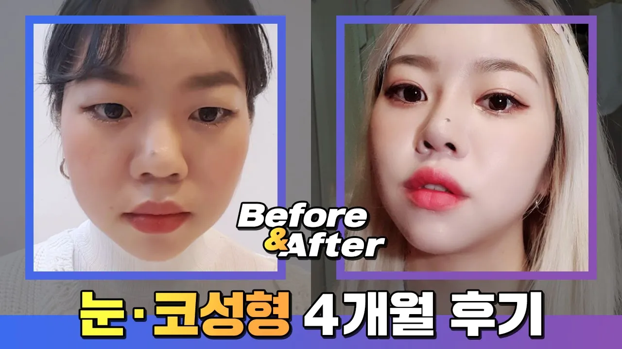 보정없는 여자 눈성형 실제후기_ 눈성형 코성형 4개월 비교후기