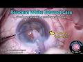 Download Lagu CataractCoach™ 2363: resident white cataract case