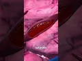 Download Lagu How A Brain Aneurysm Happens 🤔