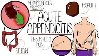 Appendicitis Made Easy